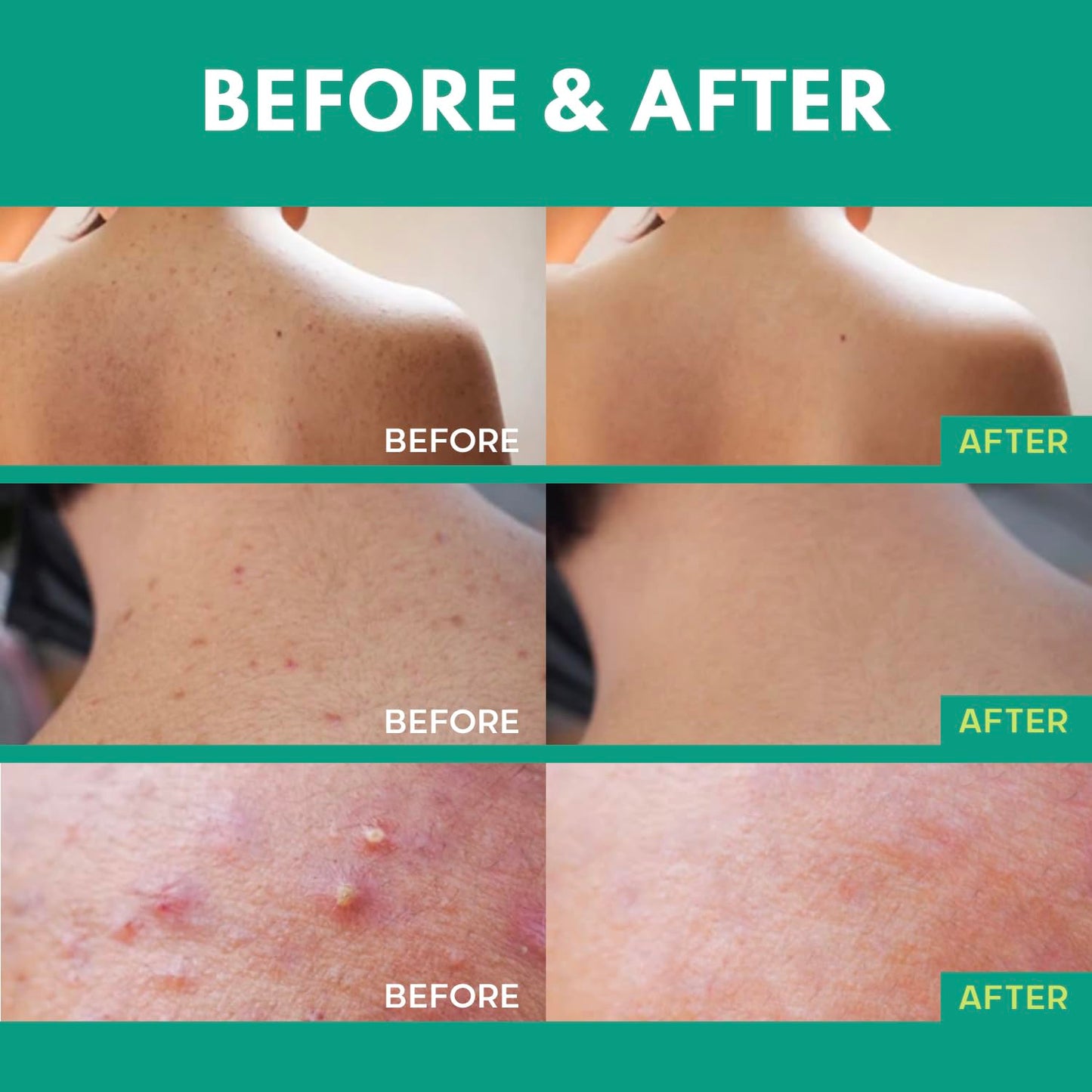 Back Acne Treatment Spray