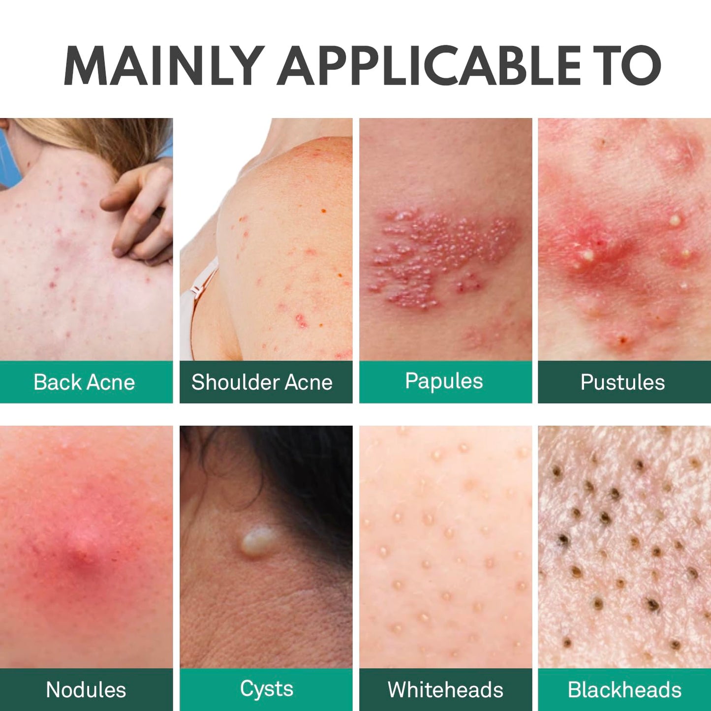 Back Acne Treatment Spray